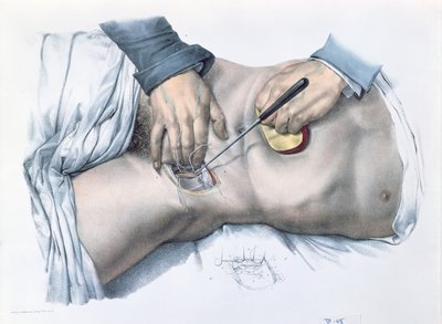 Amarrando uma artéria, placa de "Traço Completo da Anatomia do Homem" por Jean-Baptiste Marc Bourgery (1797-1849) 1866-67 de Nicolas Henri Jacob