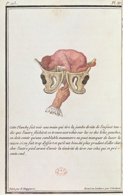 Diagrama transversal de um bebê retirado do útero pelo braço, de um livro de Madame Angelique Le Boursier du Coudray (1714-94), gravado por J. Robert, 1783 de P. Chapparre