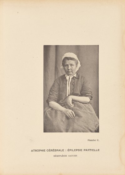 Atrofia cerebral: Epilepsia parcial Hemiplegia esquerda de Paul Marie Léon Regnard
