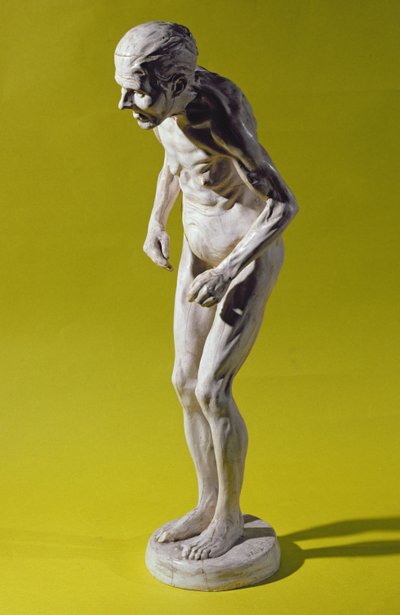 Figura de uma mulher com doença de Parkinson (gesso) de Paul Marie Louis Pierre Richer