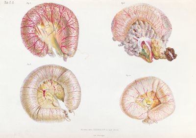 A superfície externa dos intestinos infectados com cólera, de Anatomie Pathologique du Cholera Morbus, por Nikolai Ivanovich Pirogov (1810-81), publicado em São Petersburgo, 1849 de Russian School