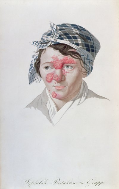 Pústulas de aglomerado sífilis, de um livro do barão Jean Louis Alibert (1768-1837) 1838 de Salvadore Tresca