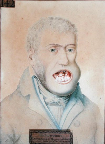 Osteosarcoma da mandíbula inferior, operado com sucesso por Guillaume Dupuytren (1777-1835) (lápis sobre papel) de School French