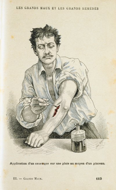 Pintando uma ferida com uma solução anti-séptica, c1890 de Unbekannt