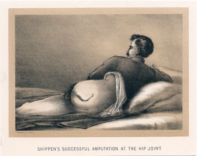 Amputação bem-sucedida de Shippens no quadril, Guerra Civil Americana, 1865 de Unbekannt