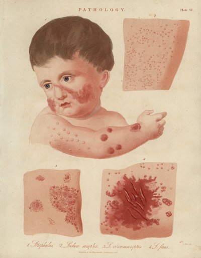 Doenças de pele dos bebés de Unbekannter Künstler