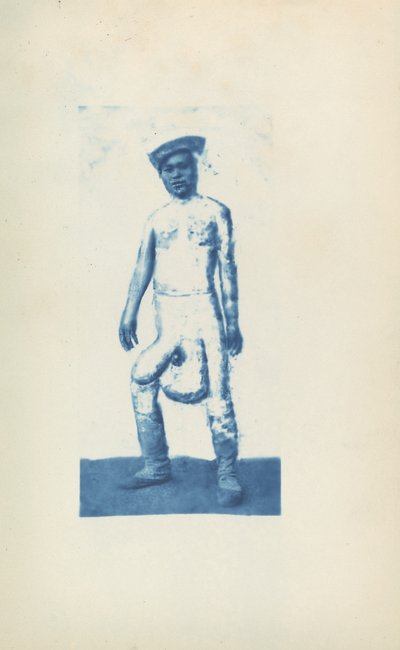 Elefantíase de Unknown 19th Century