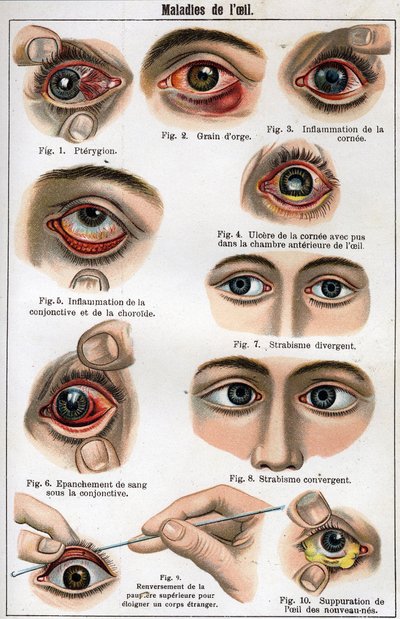 Doenças do Olho. "A nova medicina natural" por F.E. Bilz. de Unknown artist