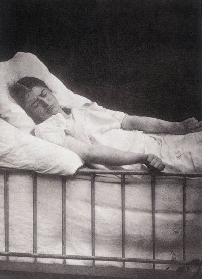 Hystero Epilepsie - Ataque tetanista na "Iconografia fotográfica da Salpétrière: serviço do Sr. Charcot" de Paul Regnard e Bourneville de Unknown artist