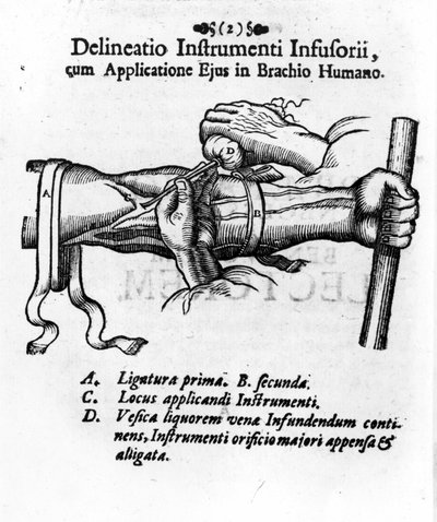 Injeção intravenosa usando uma bexiga de clister. por J. D. Mayor, "Surgery Infusoria", Kilonii 1667 de Unknown artist
