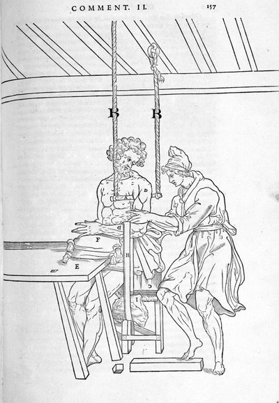 Redução de fracturas. Placa ilustrada de "De dissectione partium corporis humani lbri tres... "por Carlo Stefano Riverio, Paris 1545. de Unknown artist