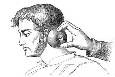 Saignee locales - aplicação de sanguessugas com maçã - gravura em "La Santo Universelle - Guia Médico para as Famílias" 1852 de Unknown artist