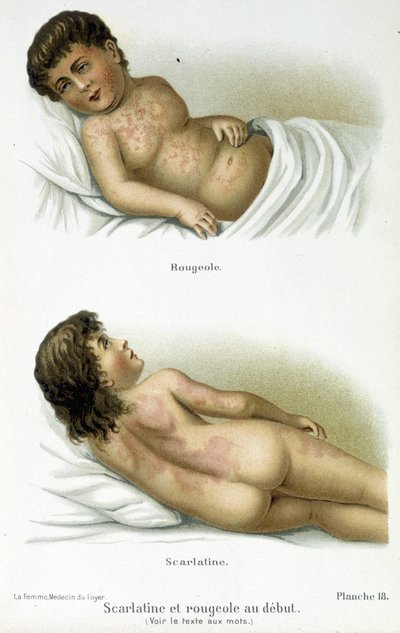 Febre escarlate e sarampo - século XIX de Unknown artist