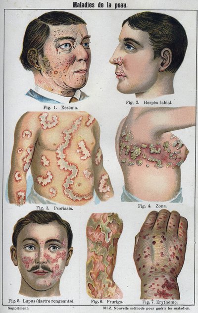 Doenças de pele: Eczema, herpes labial, psoríase, herpes zóster, lábio, prurigo, eritema". A nova medicação natural" de F.E. Bilz. de Unknown artist