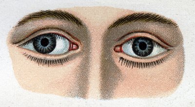 Strabismus divergente. "A nova medicação natural" de F.E. Bilz. de Unknown artist