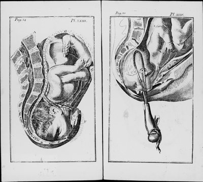 Nascimento de um bebê com uso de fórceps Placa de "Uma abreviação da prática de obstetrícia" por William Smellie (1697-1763) de Unknown artist