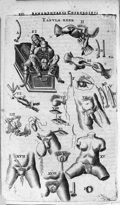 Intervenções cirúrgicas nos sexos feminino e masculino. Gravura em "Armamentarium Surgical" de J. Scultetus, Veneza de Unknown artist