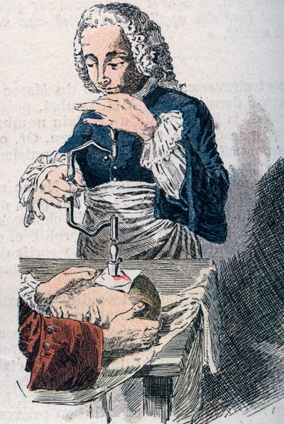 A Trepanação. A impressão do século XVIII. de Unknown artist