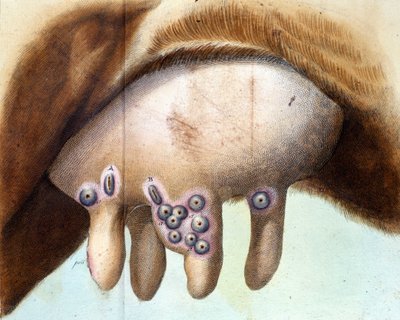 O peito de vaca usado para inocular a vacina contra a varíola por Luigi Sacco (1769-1836) em janeiro de 1801. Placa médica de "Vaccination Treat", de Luigi Sacco, Milão de Unknown artist