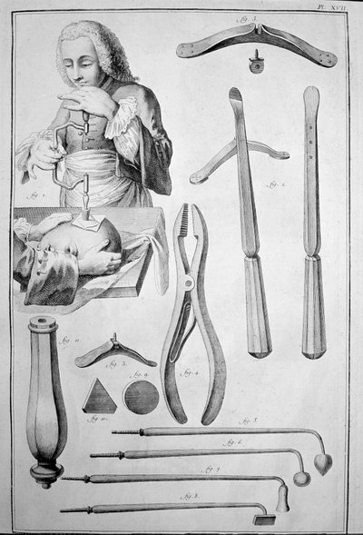 Trepanação do crânio, vários instrumentos (gravura de Unknown artist
