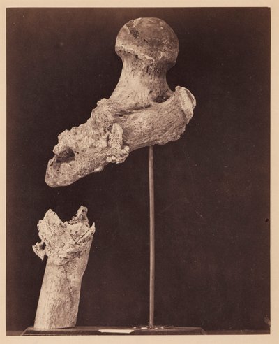 Tenente Goodwin, Falecido, Fratura de Tiro do Terço Superior do Fémur Direito, Sete Meses após o Ferimento, do Catálogo Fotográfico da Secção Cirúrgica de William Bell