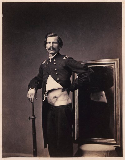 Major H. A. Barnum, Recuperação após um ferimento penetrante de bala no abdómen com perfuração do ílio esquerdo, do Catálogo Fotográfico da Secção de Cirurgia de William Bell