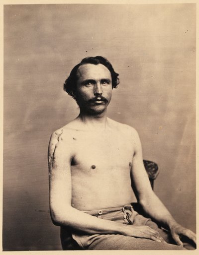 Soldado Adolph Zirsse, Excisão intermédia bem sucedida da cabeça e duas polegadas e meia do eixo do úmero direito, do Catálogo Fotográfico da Secção Cirúrgica de William Bell