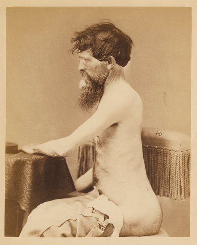 Soldado John Bar, Recuperação após um ferimento penetrante no abdómen com fratura do Os Innominatum esquerdo, do Catálogo Fotográfico da Secção Cirúrgica de William Bell