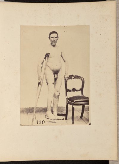 Fratura consolidada por projétil de arma de fogo do terço médio do fémur direito de William H. Bell