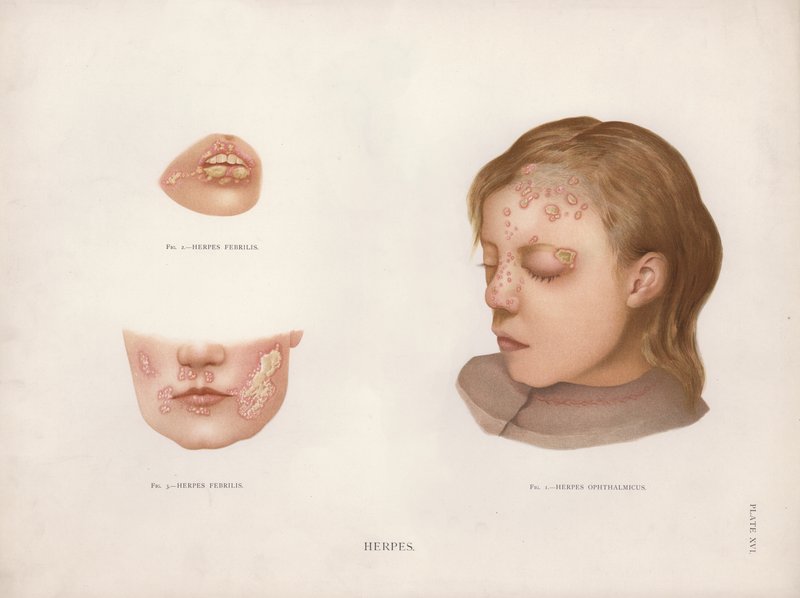 Doenças da pele: Herpes (cor litho) de English School