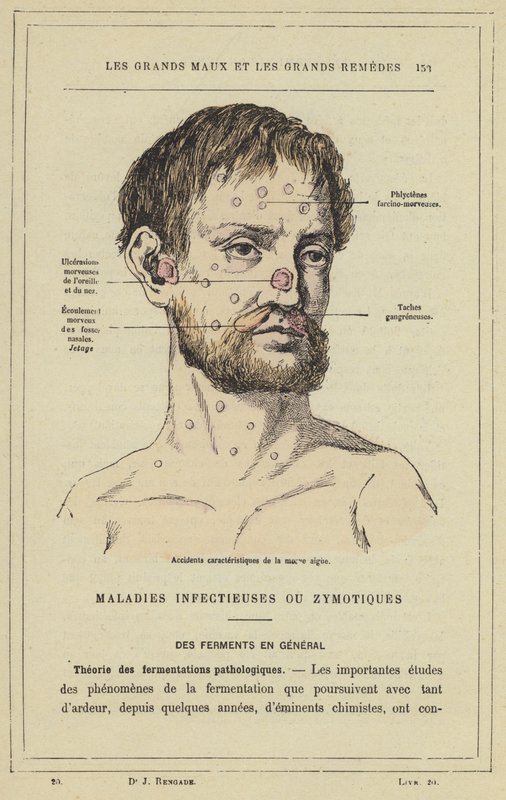 Acidentes característicos de mormo agudo (cor litho) de French School
