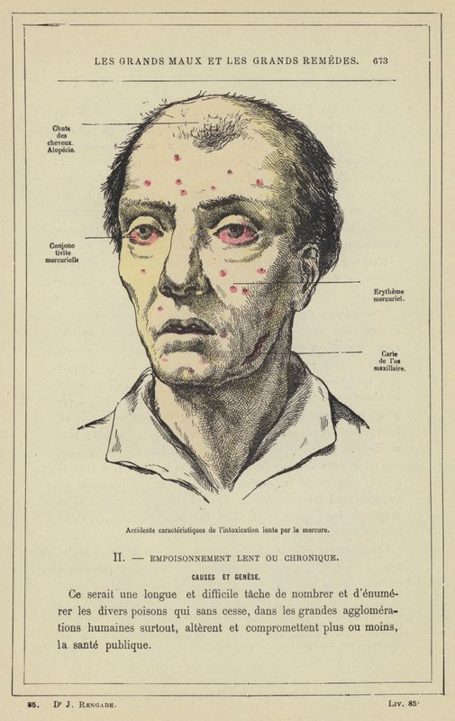 Acidentes característicos de envenenamento por mercúrio lento (cor litho) de French School