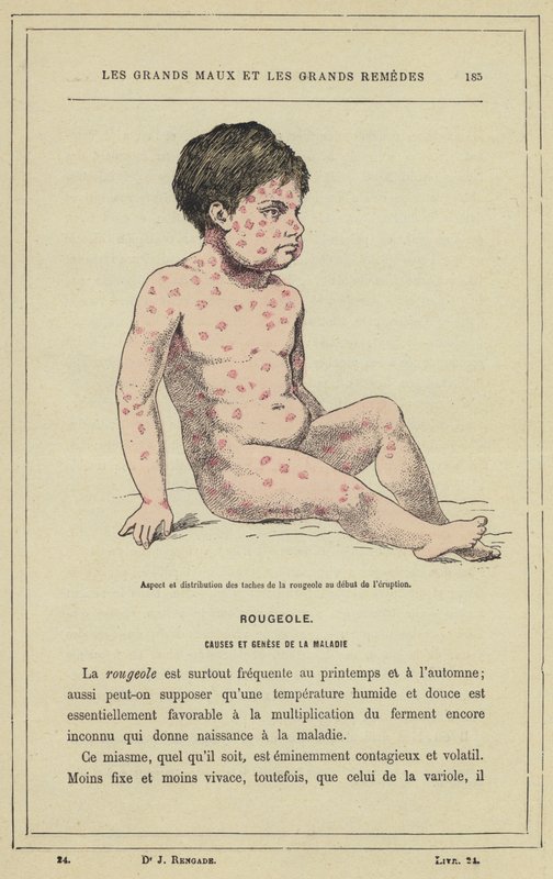 Aspecto e distribuição das manchas de sarampo no início da erupção cutânea (cor litho) de French School