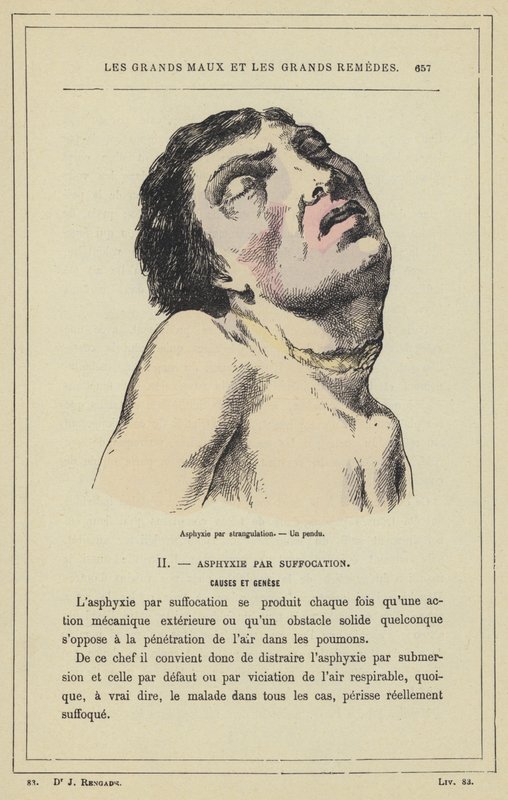 Asfixia por estrangulamento, Um homem enforcado (cor litho) de French School
