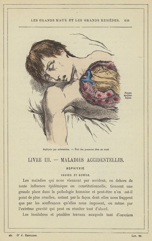 Asfixia por submersão, estado pulmonar em pessoa a afogar-se (cor litho) de French School