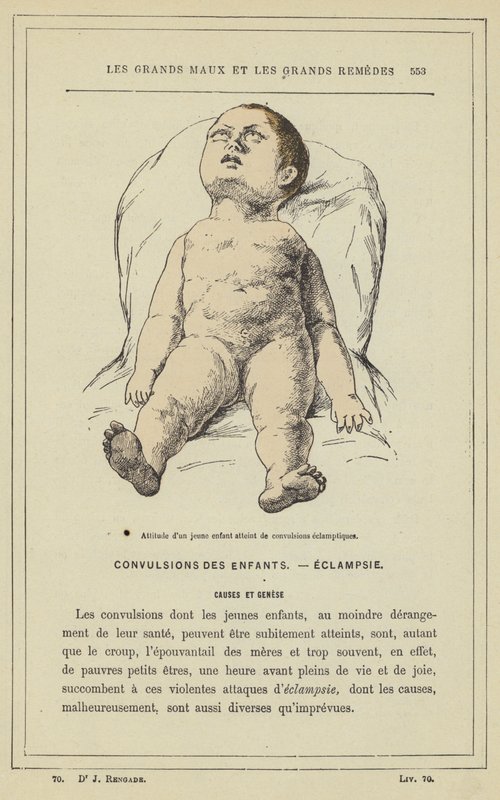 Atitude de uma criança pequena com convulsões eclâmpticas (cor litho) de French School