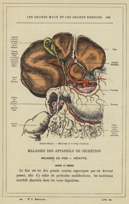 Gallstones, Mecanismo de cólica hepática (cor litho) de French School