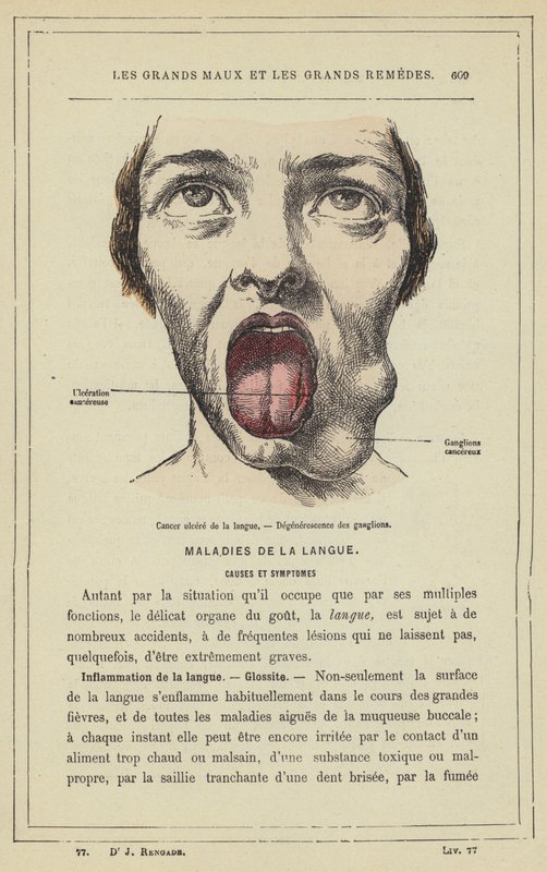 Úlcera de língua cancerígena, Degeneração do nó (cor litho) de French School