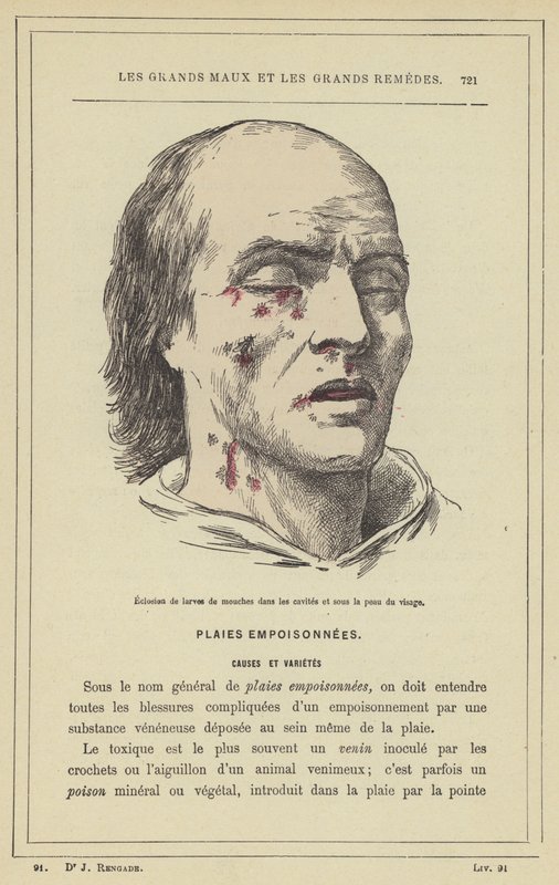 Incubação de larvas de mosca nas cavidades e sob a pele do rosto (cor litho) de French School
