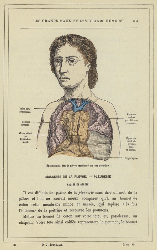 Efusão na pleura causada por uma pleurisia (cor litho) de French School