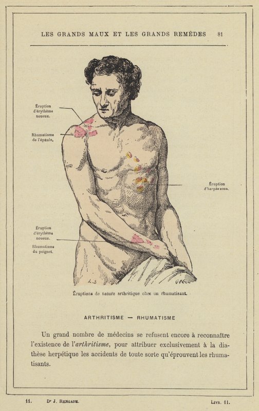 Erupção artrítica num paciente reumático (cor litho) de French School