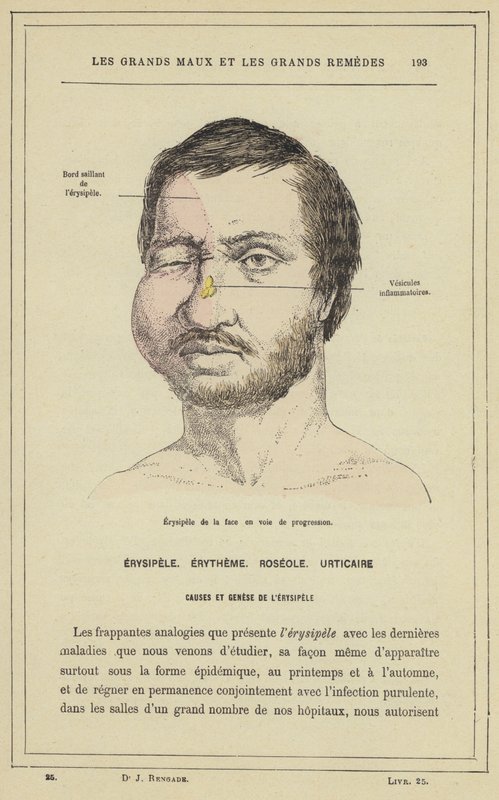 Erysipelas do rosto em progresso (cor litho) de French School