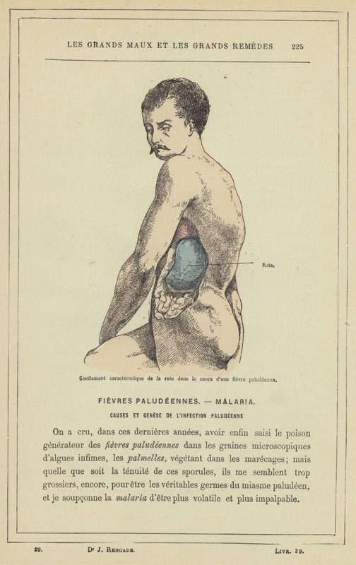 Inchaço característico do baço no decurso de uma febre malária (cor litho) de French School