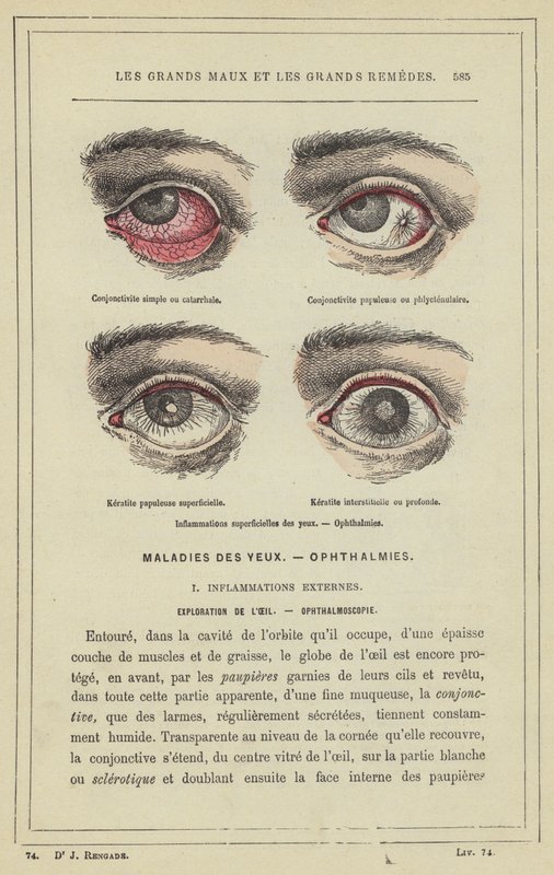 Inflamação superficial dos olhos, Ophthalmia (cor litho) de French School