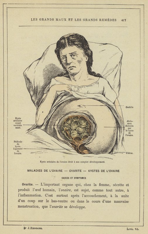Cisto areolar do ovário direito em seu pleno desenvolvimento (cor litho) de French School