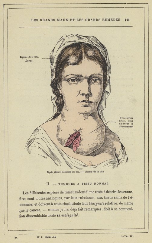 Cisto seroso do pescoço, lipoma da cabeça (cor litho) de French School