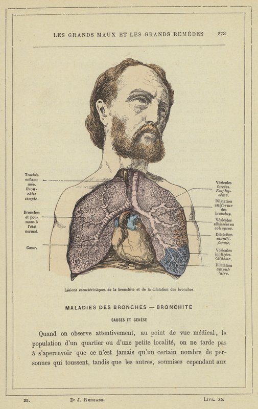 Lesões características da bronquite e da dilatação brônquica (cor litho) de French School