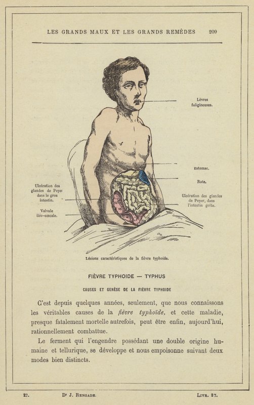 Lesões características da febre tifóide (cor litho) de French School