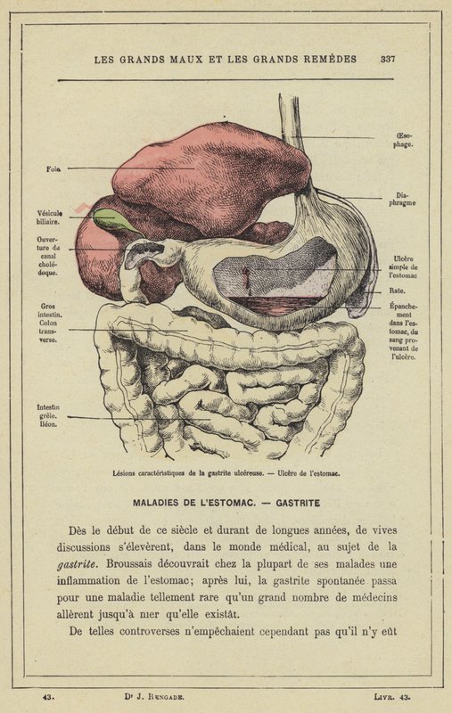Lesões características da gastrite ulcerosa, úlcera do estômago (cor litho) de French School