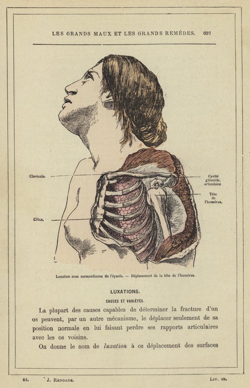 Deslocamento subcoracoide do ombro, deslocamento da cabeça do úmero (cor litho) de French School